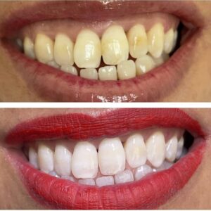 Blanchiment des dents Sfax / Dr Oumaima Souissi
