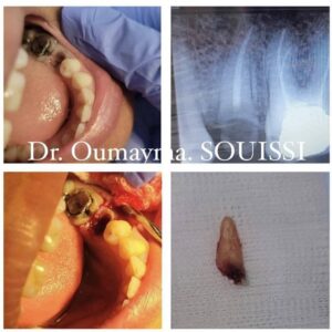 dentiste Dr Oumayma Souissi / extraction des dents
