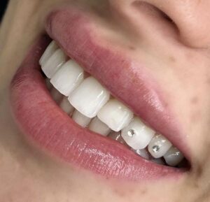 strass dentaire à Sfax / Bijoux dentaires chez Dr Oumaima